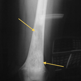 Hemangioendothelioma