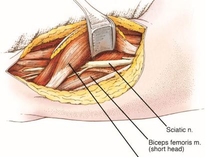 Muscle Retraction