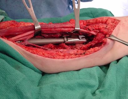 Intra-Op: Distal Humerus Prosthesis Inserted