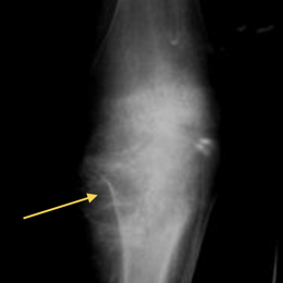 Conventional Osteosarcoma