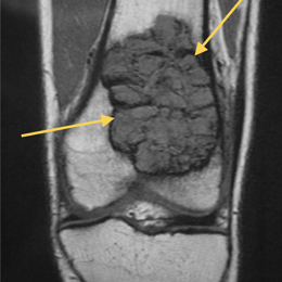 Giant Cell Tumor of Bone