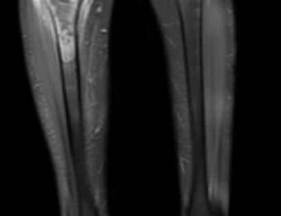 Pre-Op MRI of Tumor