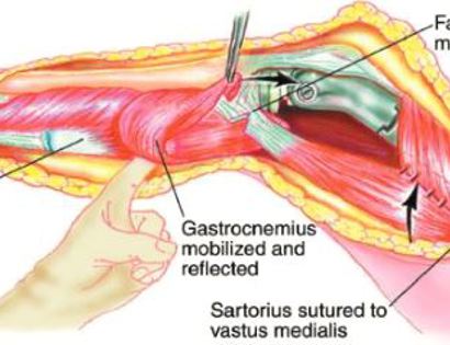 Soft Tissue Coverage 