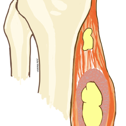 Radical Resection of Soft Tissue Tumors