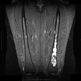 7D Chondrosarcoma Mri Coronal Stir Of The Left Femur Jw2 (1)