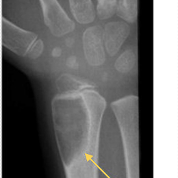 Osteoblastoma