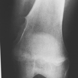 Periosteal Chondroma Distal Femur XR