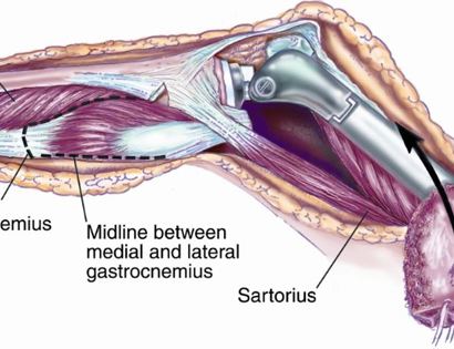 Soft Tissue Coverage