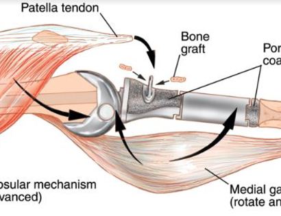 Prosthesis Inserted Schematic