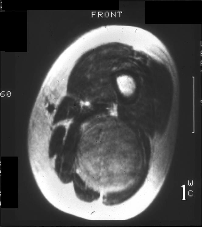 Neurofibroma