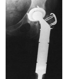 Proximal Femur Tumor Replacement