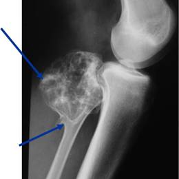 Osteochondroma9