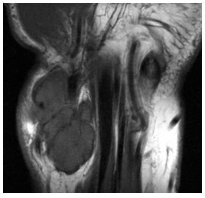 GCT Tendon Sheath MRI