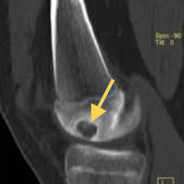 Chondroblastoma