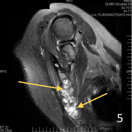 Fibrous Dysplasia