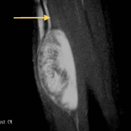 Nerve Tumor (Schwannoma)