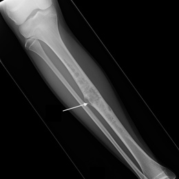 98A) Plain AP X Ray Of Right Tibia Adamantinoma