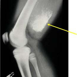 Mesenchymal Chondrosarcoma