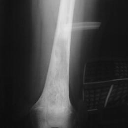 12A)Plain Radiograph Of Epithelioid Hemangioendothelioma Of Femu (1)