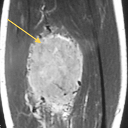 Alveolar Soft Part Sarcoma