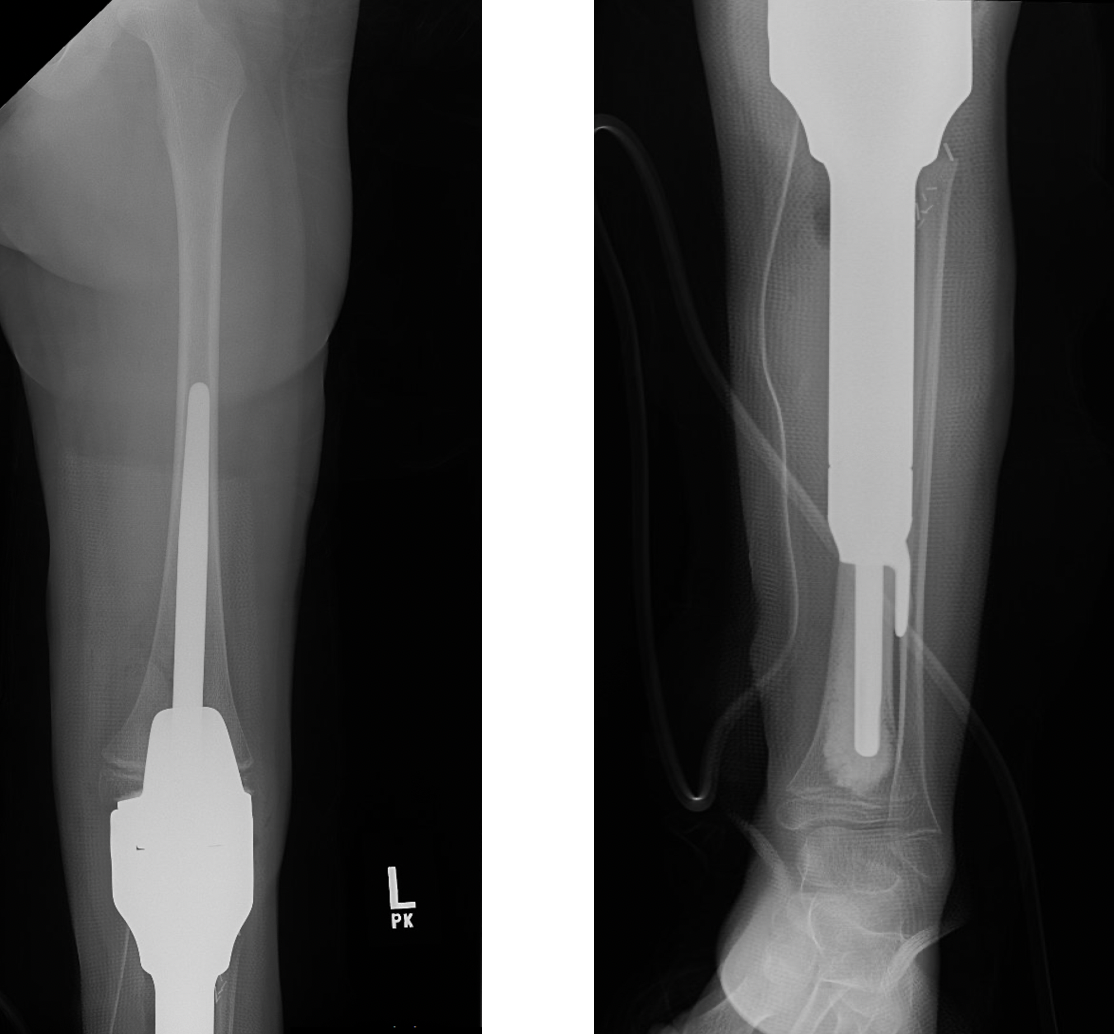 Proximal Tibial Prosethesis