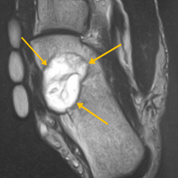 Chondromyxoid Fibroma